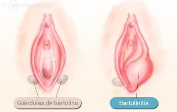 Inflamación de las glándulas de Bartolino Causas de la bartolinitis