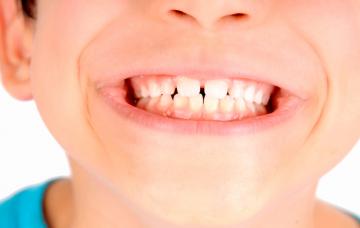 Causas del bruxismo Causas del bruxismo