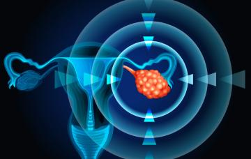 Causas de tumores de ovario