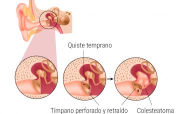 Causas del colesteatoma y tipos
