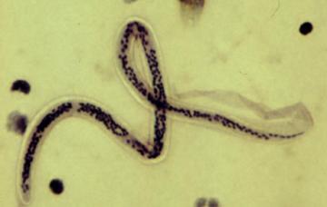 Causas de elefantiasis