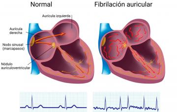 Causas y factores de riesgo de la fibrilación auricular Factores de riesgo de la fibrilación auricular
