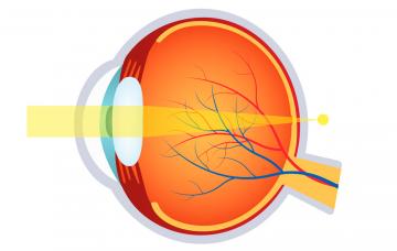 Ilustración de las causas de hipermetropía
