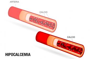 Causas de la hipocalcemia
