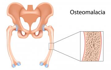 Causas de la osteomalacia