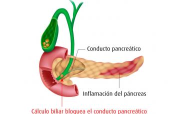 Ilustración de las causas de pancreatitis