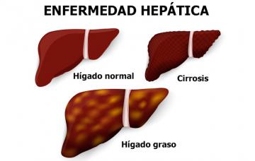 Ilustración de las causas y tipos de hepatitis