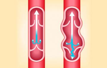Causas de la trombosis venosa