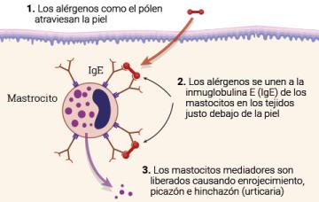 Causas de la urticaria Ilustración de las causas de la urticaria