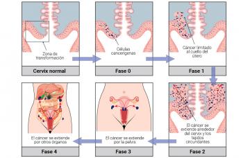 Clasificación del cáncer de cuello de útero