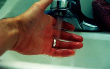 Cómo actuar ante una quemadura