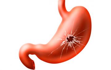 Complicaciones de una úlcera Complicaciones de una úlcera