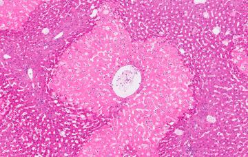 Cirrosis Complicaciones de la cirrosis