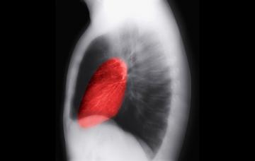 Radiografía de tórax muestra complicaciones por colesterol alto