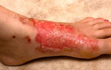 Pie afectado por claros signos de alarma de quemadura