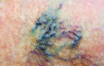 Complicaciones de varices en la piel