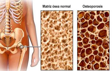 Ilustración de la densidad ósea en la osteoporosis