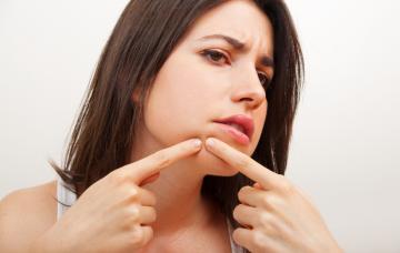 Chica con puntos negros del acné