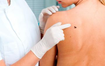 Síntomas del cáncer de piel Una dermatóloga examina un lunar en la espalda de una paciente
