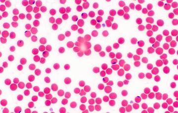 Frotis de sangre Diagnóstico de la enfermedad de Chagas