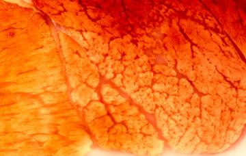 Diagnóstico de la distrofia muscular de Duchenne