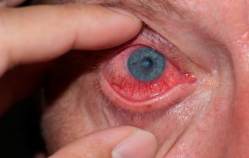 Ojo afectado por un diagnóstico de la enfermedad de Behçet Diagnóstico de la enfermedad de Behçet