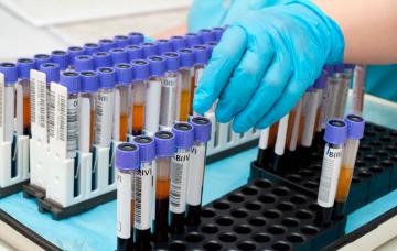 Diagnóstico de esteatosis hepática Muestras de sangre para analizar en el laboratorio