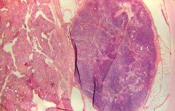 Diagnóstico del hipertiroidismo por gammagrafía