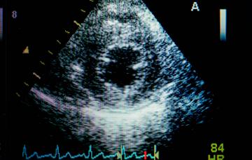 Diagnóstico de la insuficiencia mitral Diagnóstico de la insuficiencia mitral