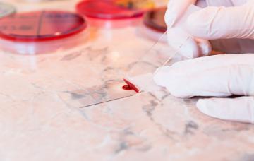 Diagnóstico de la leucemia Diagnóstico de la leucemia