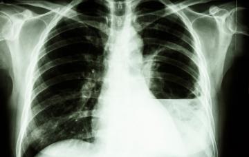 Diagnóstico de la melioidosis Radiografía de tórax