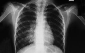 Diagnóstico del neumotórax Diagnóstico del neumotórax por radiografía