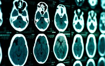 Diagnóstico de parálisis cerebral