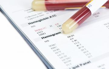 Diagnóstico del Síndrome de Rett