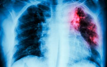 Diagnóstico de sarcoidosis Diagnóstico de sarcoidosis