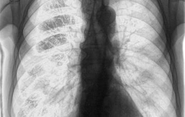 Diagnóstico de la tuberculosis por radiografía de tórax