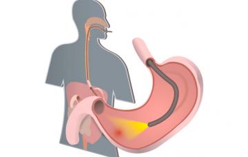 Diagnóstico de una úlcera Diagnóstico de una úlcera