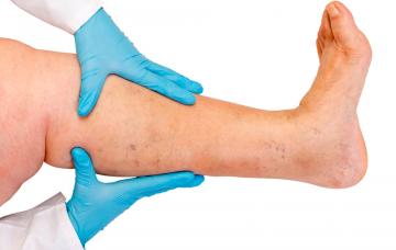 Diagnóstico de varices en consulta