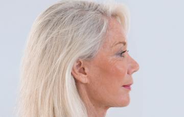 Afectada por glaucoma de ángulo abierto Glaucoma de ángulo abierto