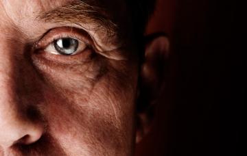 Ojos afectado por glaucoma de ángulo estrecho Glaucoma de ángulo estrecho