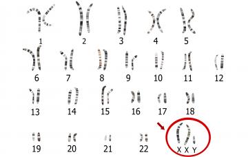 Diagnóstico del síndrome de Klinefelter