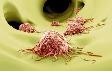 Expansión del cáncer de mama