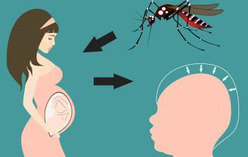 Microcefalia Virus zika y microcefalia