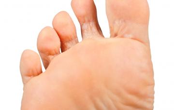 Escamaciones sintomáticas de pie de atleta