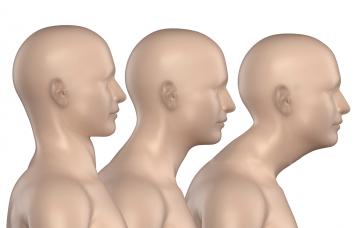 Ángulo de la curva escoliótica