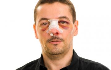 Primeros auxilios en una fractura nasal