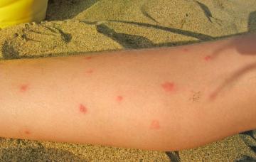 Síntomas del dengue Síntomas del dengue en la piel