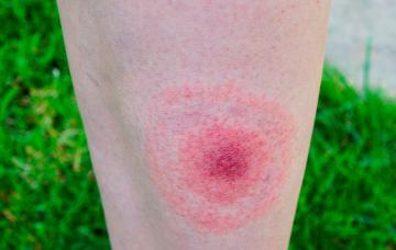 Eritema migrans: síntoma de la enfermedad de Lyme Síntomas de la enfermedad de Lyme