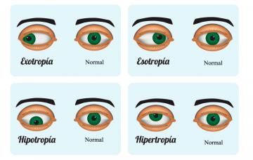 Síntomas del estrabismo