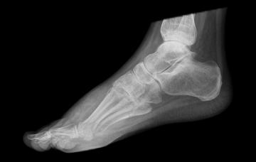 Diagnóstico de la fascitis plantar